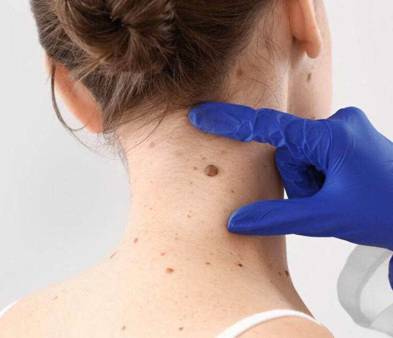 Skin Tag Removal