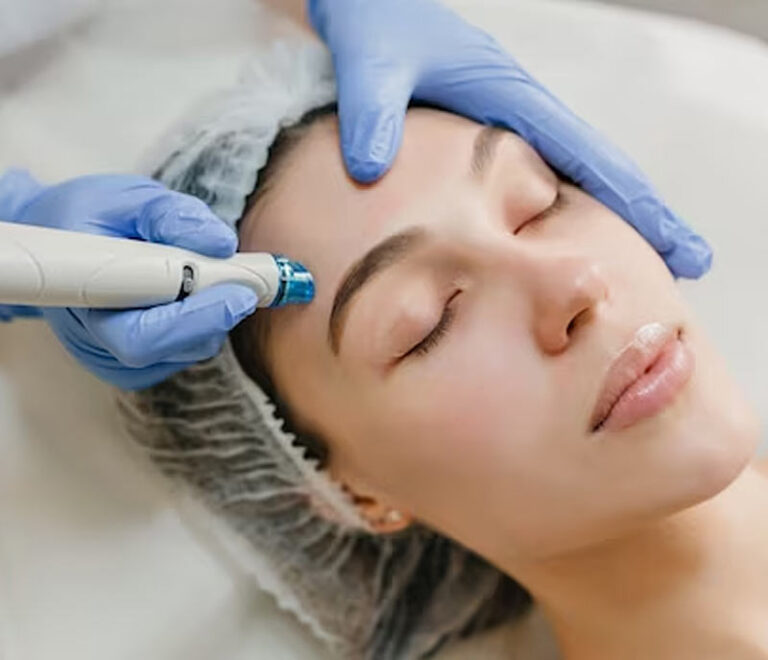 Microneedling